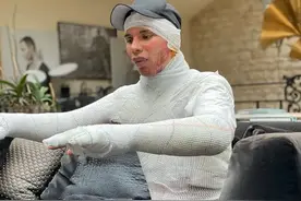 他被嘲“整形怪”10年！如今自曝毁容烧伤照，网友：又来炒作图片