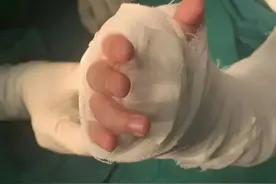 拯救“折翼天使”，北京积水潭医院手外科成功完成幼儿断腕再植图片