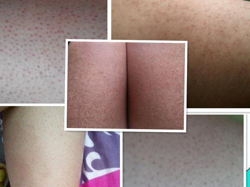 如何没有鸡皮肤