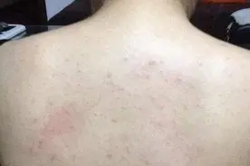 前胸后背长痘痘，一直不好怎么办？难怪了，平时不做好3件事图片