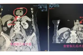 83岁老人胃“移位”突发呕血 原来是患上了这个病图片