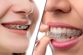 隐形矫正牙套和钢丝矫正牙套哪个速度快哪个效果好？图片