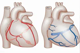 心肌桥——心脏上的一座“桥”，有什么危害？要如何治疗？图片