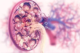 肾囊肿的原因是啥，会恶变吗？什么情况要考虑手术呢？医生告诉您图片