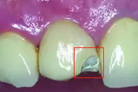 烤瓷牙什么时候该换了？崩瓷变黑之后就要警惕了，看完长知识了图片