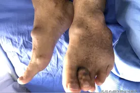 我和我20多年的婚姻，因为痛风20年的丈夫长出痛风石遭遇考验图片