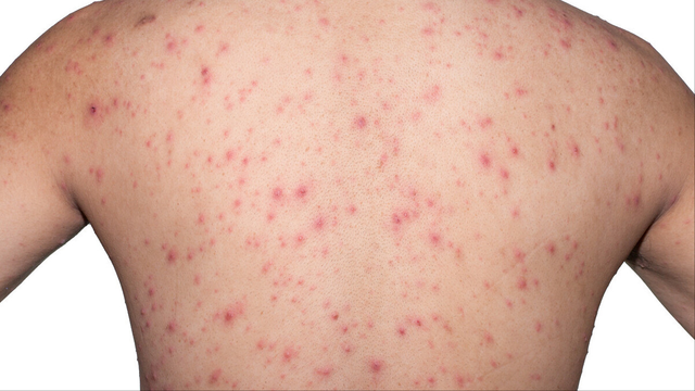 鸡皮肤可以永久去掉吗