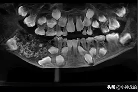 长526颗牙齿是啥感觉？印度7岁男孩经历过，张嘴就吓坏众人图片