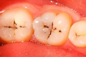 后牙槽上的谜之黑线，怎么才能刷干净？图片