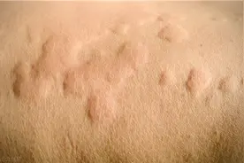 荨麻疹瘙痒难忍，反复发作，如何破解？图片