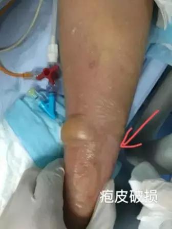 复方氨基酸外渗竟会如此严重？你说怎么办？