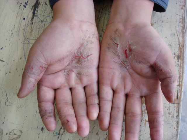 角化皲裂型手癣涂什么药膏好