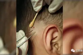4岁男孩皮肤下有一根黑线，还会动！医生惊了：国内仅见3例图片