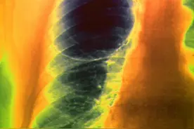 什么是肺大疱？被查出肺大疱应该怎么办？医生告诉您答案图片