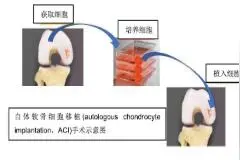 关节软骨的修复与修复失败图片