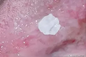舌头上长白斑，可能是癌前病变，这些人要格外注意图片