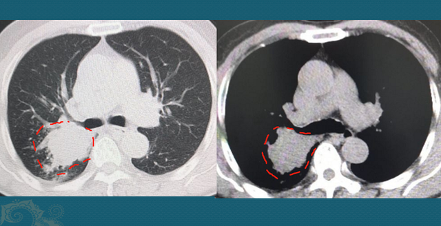 非角化鳞癌原位红肿痒是复发了吗