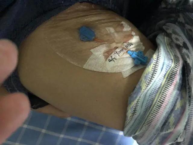 静脉输液部位选择不简单，一不小心竟“误入歧途”