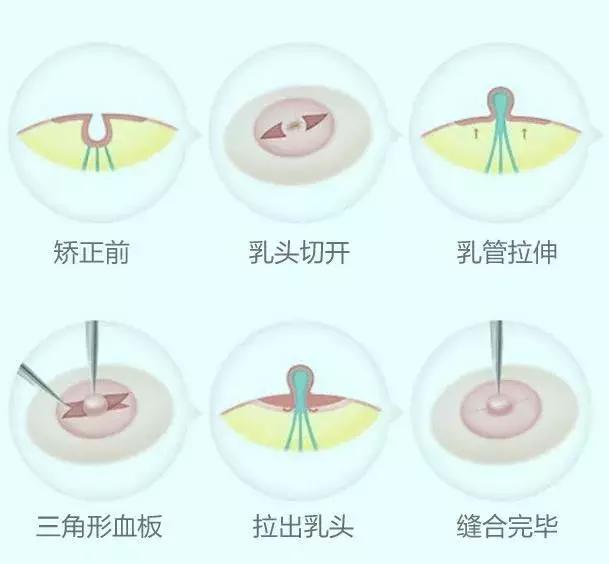 全面解析乳头内陷,预防保健很重要