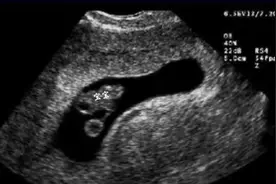 孕期非要不可的几次超声检查，孕妈妈再忙也要做！图片