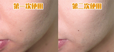 去粉刺毛囊炎痤疮鸡皮身体乳