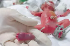 出生仅400g！湖南最轻的“巴掌公主”活下来了！看完让人泪目…图片