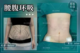 苹果型身材你知道多少？腰腹吸脂更容易改善苹果型身材哦图片