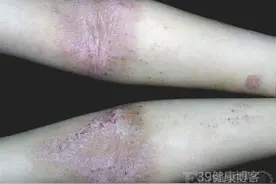 80%的湿疹在医院可以得到迅速治疗和控制，我的湿疹为什么老不好图片