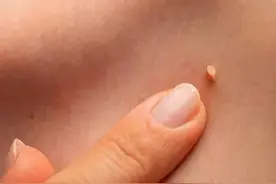 皮肤上长的小肉疙瘩 能自己剪掉吗图片