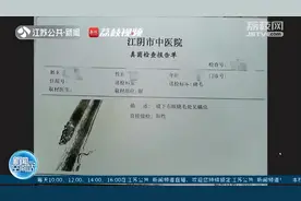 可怕！女子种睫毛引起眼部螨虫感染图片