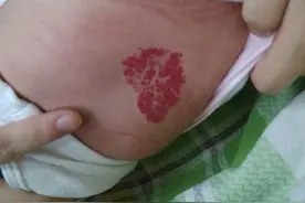 预防血管瘤的几大绝招图片