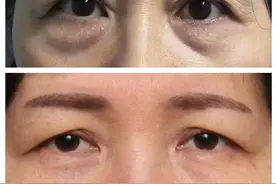 "切眉+去眼袋"后的她重返青春！但这些你需要注意图片
