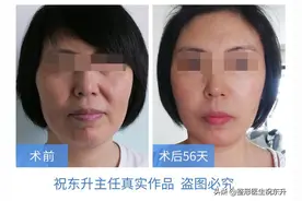 作为一个过来人，我来公开做“拉皮手术”的全部细节图片