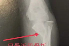 学习《X线读片指南》骨、关节系统——尺、桡骨图片
