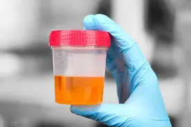 肾炎的早期信号，看一下图片