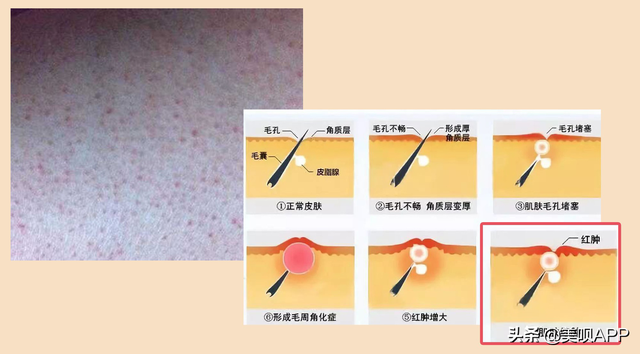 脱毛膏会毛周角化吗