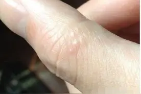 手上长小水泡，瘙痒还脱皮，能根治吗？医生：3个方法可不复发图片