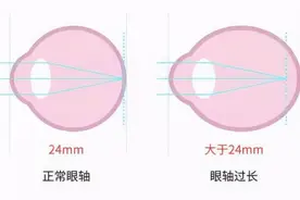 儿童青少年眼部发育与近视的关系，您知道吗？图片