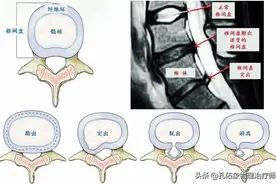 腰椎间盘突出后，该怎么办？如何选择治疗？请收藏图片