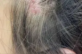 热玛吉、线雕、小拉皮、大拉皮等，说说我的亲身经历与感受图片