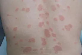 泛红？起皮？瘙痒？小心是脂溢性皮炎在作怪图片