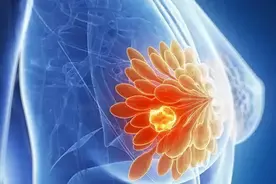 乳腺癌患者出现肺转移怎么办？如何治疗？——乳腺癌与肺转移图片