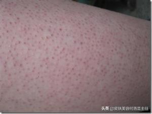 治疗鸡皮疙瘩的方法