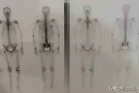 骨显像（ECT）浓聚是否是肿瘤骨转移，说说癌症患者骨转移诊断图片