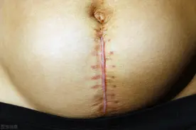 剖腹产后月子里，到底能不能洗澡？图片