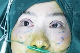 35岁老阿姨全脸整容术后两个月，闺蜜说换了一张脸年轻20岁图片