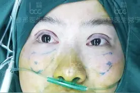 35岁老阿姨全脸整容术后两个月，闺蜜说换了一张脸年轻20岁图片