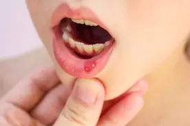 16岁女孩，口唇持续溃疡，去医院检查，发现是因为感染了HPV图片