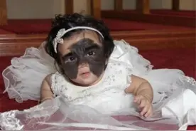 女宝脸部被胎记覆盖，被称“蝙蝠侠宝宝”，8次手术后怎样了？图片