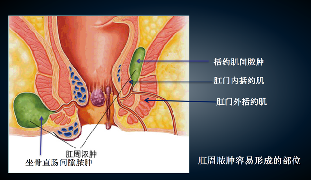 肛周脓肿要手术吗？